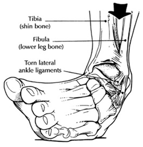 Ankle Injury Physiotherapy Treatment