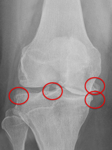 Image result for osteophytes arthritis