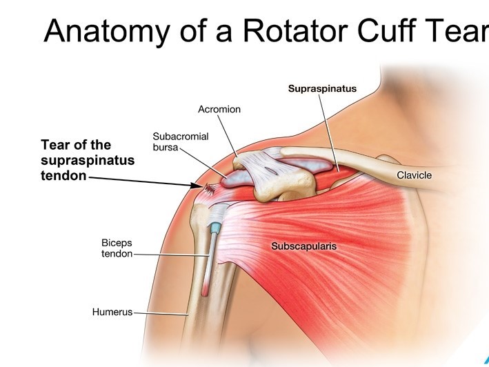 Rotator cuff tear - what's involved