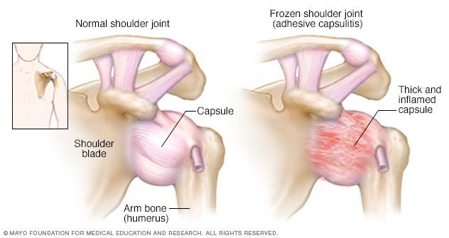 Image result for frozen shoulder