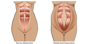 abdominal diastasis/separation