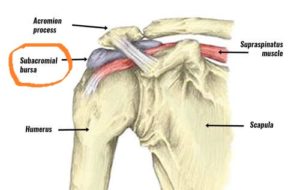 Shoulder bursitis image