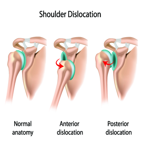 Image result for shoulder joint dislocation