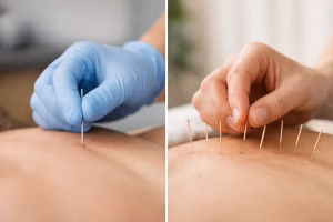 Dry Needling vs Acupuncture: What Changes?