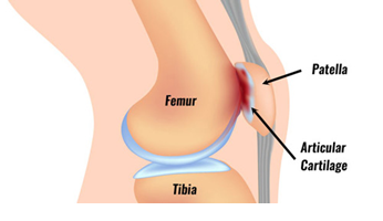 patellofemoral joint